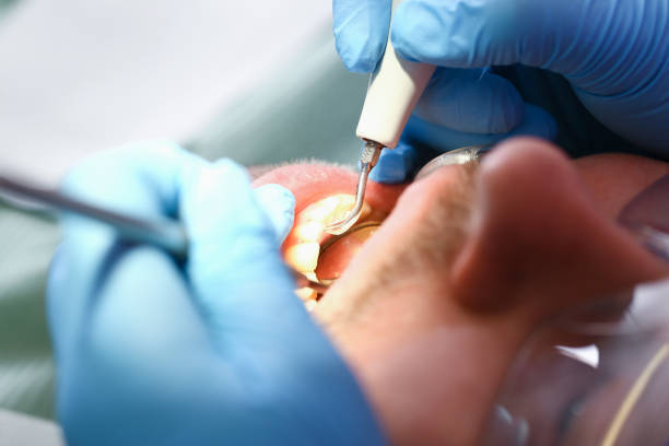 Best Emergency Tooth Extraction in Sandy Springs, GA