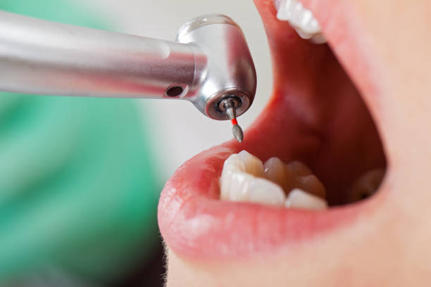 Best Emergency Treatment for Toothache in Sandy Springs, GA